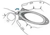 Click Dome removal tool  